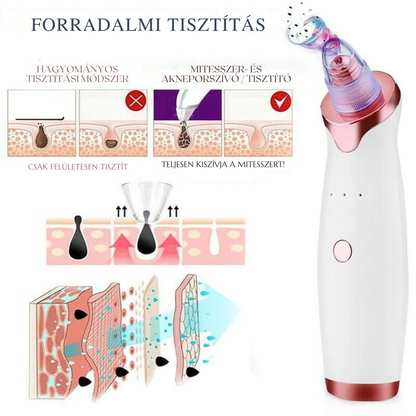 Aknéeltávolító™ – Hatékony és fájdalommentes tisztítás