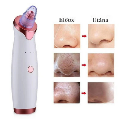 Aknéeltávolító™ – Hatékony és fájdalommentes tisztítás