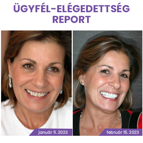 Fogszínkorrektor és zománcápoló szérum